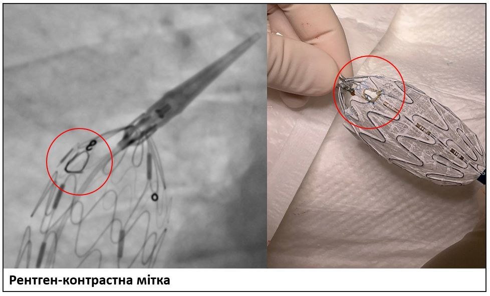 В Україні вперше застосували техніку Branched TEVAR