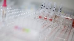 Novartis зацікавилася лікуванням серповидно-клітинної анемії