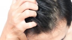 Інновації у лікуванні облисіння: новий препарат забезпечив безперервний ріст волосся протягом року