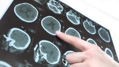 ЧМТ, вероятно, повышает риск развития бокового амиотрофического склероза