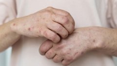 У 2024 році МОЗ зафіксувало п’ять випадків захворювання на кір