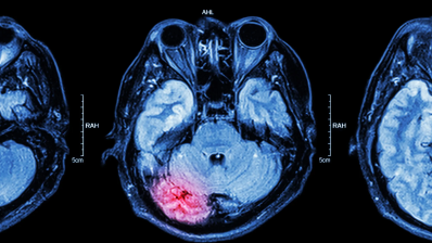 Железные «пятна» – потенциальный биомаркер травмы мозга