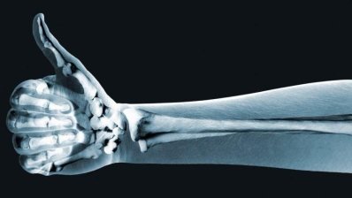 Абалопаратид улучшит прочность костей при остеопорозе