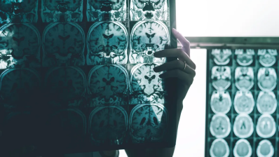 FDA затвердило новий препарат від хвороби Альцгеймера