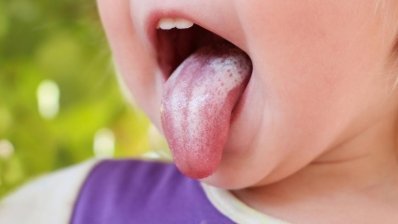 Кандидоз полости рта – дискомфорт плюс риск грозных осложнений