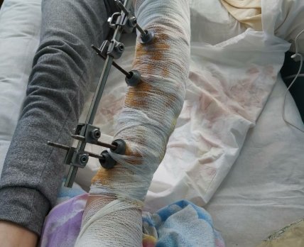 Українські лікарні отримають апарати для фіксації кінцівок /МОЗ
