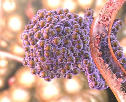 Вчені зʼясували, як утворюються метастази – рак «протікає» в організм через судини