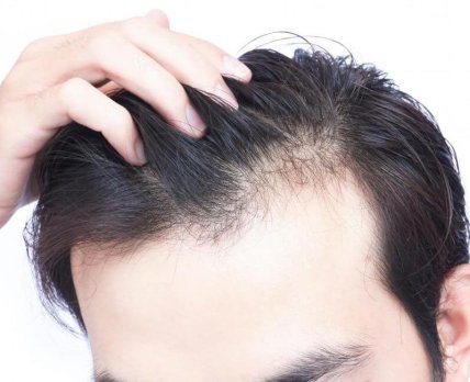 Новое открытие поможет разработать эффективные препараты от выпадения волос