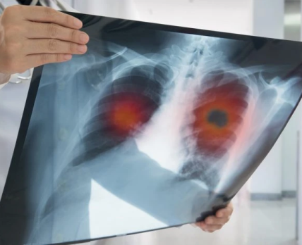 В Україні стартувала інформаційна кампанія проти раку легень «Пройди діагностику»
