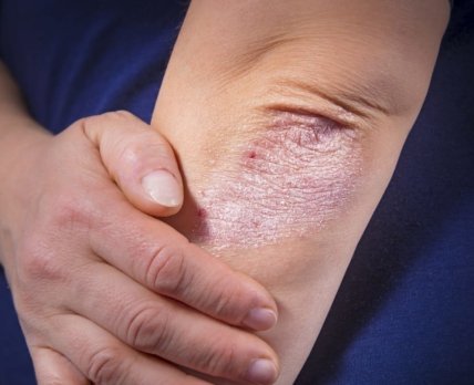 Новое лекарство очищает кожу от псориаза на 4 года