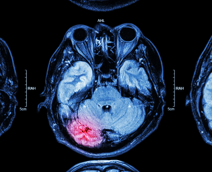 Железные «пятна» – потенциальный биомаркер травмы мозга