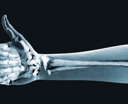 Абалопаратид зміцнить кістки при остеопорозі