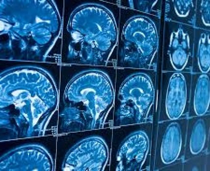 Перспективное лекарство от бокового амиотрофического склероза проверят также при болезни Альцгеймера