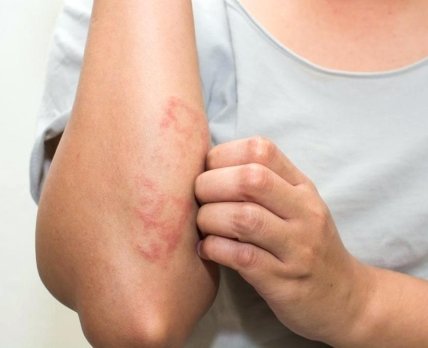 Исследователи обнаружили возможную взаимосвязь между атопическим дерматитом и опухолями кожи и почек