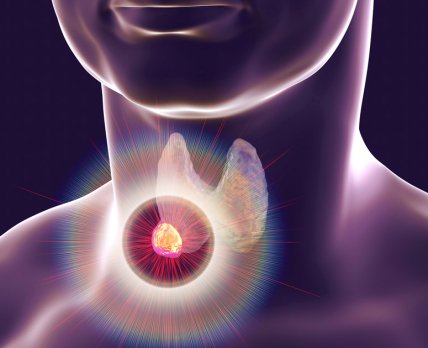 Вчені визначили країни, де зростає захворюваність на рак щитовидки