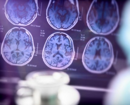 Eli Lilly поспішає зареєструвати власні ліки від хвороби Альцгеймера