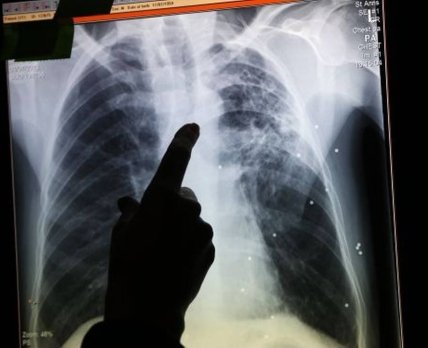 Новое поколение лекарств демонстрирует эффективность при резистентном туберкулезе
