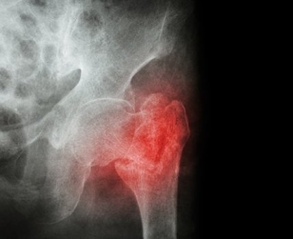 Затверджено новий препарат для лікування чоловіків з остеопорозом та високим ризиком переломів