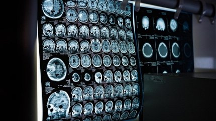 Новий візуалізаційний агент прискорить діагностику хвороби Альцгеймера