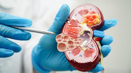 Otsuka Pharmaceutical стремится получить полное одобрение Voyxact при IgA-нефропатии&amp;nbsp;&amp;nbsp;