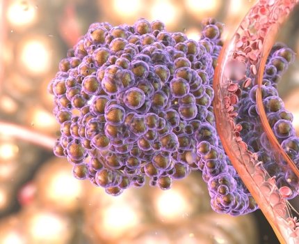 Ideaya Biosciences испытала перспективный препарат для лечения увеальной меланомы