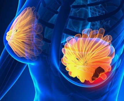 Лучшее лечение рака молочной железы: Astrazeneca и Daiichi Sankyo обходят конкурентов