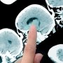 Застосування нового нейропротектора при інсульті дало «суперечливі, але інтригуючі» результати
