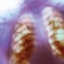 Препарат от муковисцидоза спасает от смерти в результате острого респираторного дистресс-синдрома