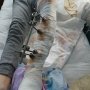 Українські лікарні отримають апарати для фіксації кінцівок /МОЗ