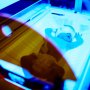 Розроблено генну терапію синдрому Криглера-Найяра