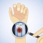 Дослідники зʼясували, як підібрати безпечну дозу глюкокортикоїдів при ревматичних захворюваннях