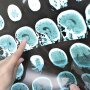 Оптимизированная диагностика рассеянного склероза поможет предотвратить потерю зрения