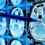 Экспресс-оценка при подозрении на транзиторную ишемическую атаку: новое положение Американской кардиологической ассоциации