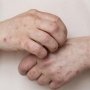 Європі потрібно подолати спалахи кору