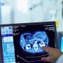З'явився ще один препарат для лікування бічного аміотрофічного склерозу