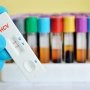 Риск рака печени сохраняется даже после излечения от гепатита С