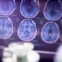Eli Lilly спешит зарегистрировать собственное лекарство от болезни Альцгеймера