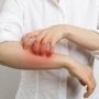Чесотка: что рекомендовать из лекарств?